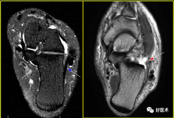距腓前韧带MRI图片