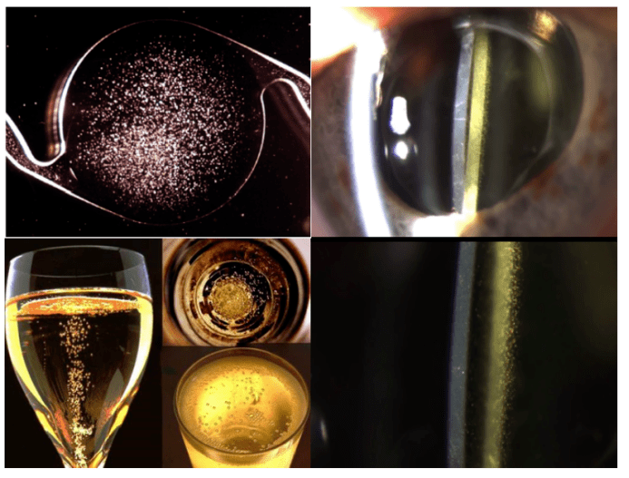 在上篇,我们讲到了一种现象,白内障术后患者的眼中居然也会出现"香槟