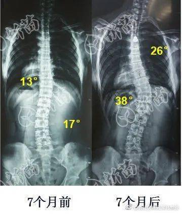 我得脊柱侧弯了吗?「ai 专家」为你免费检测