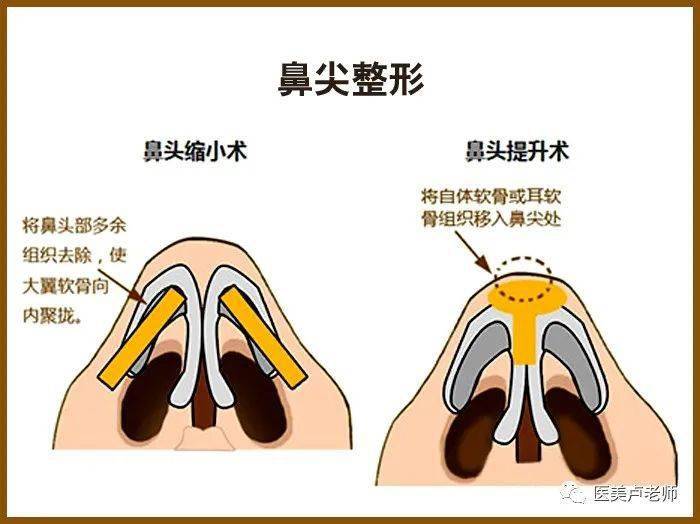 鼻尖整形美容术中的缝合技术