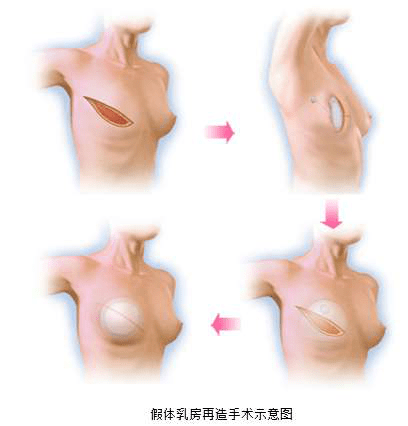 乳房一侧塌陷图片图片