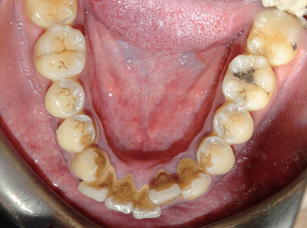 下颌舌侧骨隆突图片