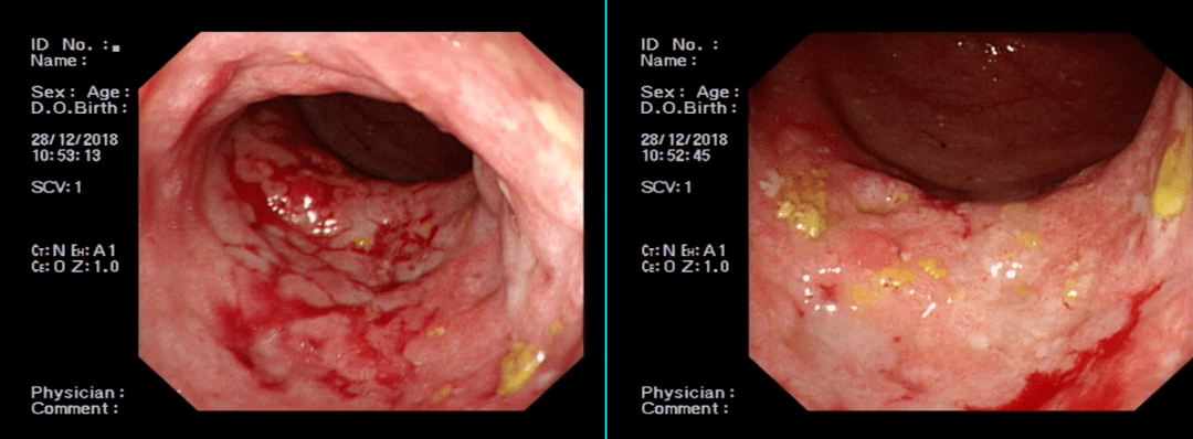 管腔狭窄,糜烂出血.