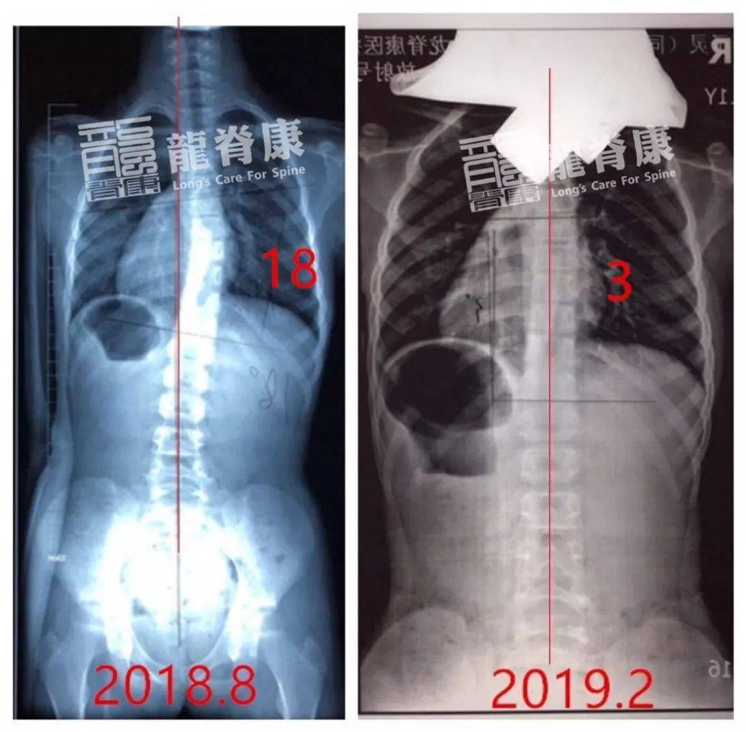 奋战5个月,11岁女孩剃刀背从10°减至0°,侧弯从18°减至3°!_支具