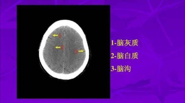 頭顱ct檢查報告單上提示有:腦萎縮,很嚴重?醫生闢謠跟您說清楚