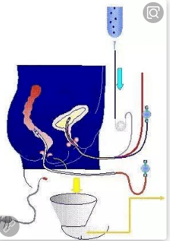 尿动力学检查都查点啥