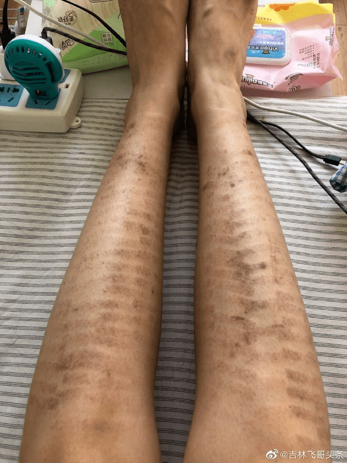 网爆吉林市一女子在美容院做的冰点脱毛,结果挺好的一双大白腿给弄成