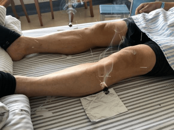 第九八三医院中医内分泌科开展温针灸治疗糖尿病周围神经病变效果显著