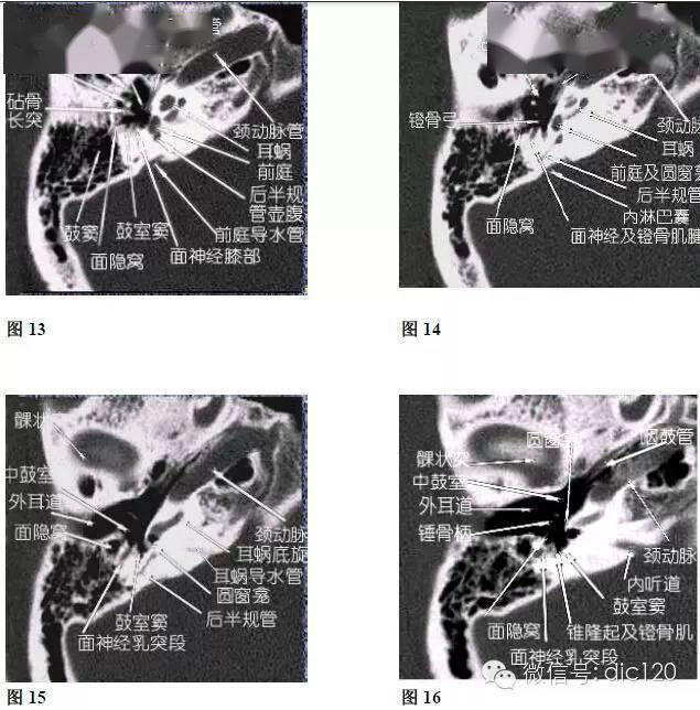 内耳ct解剖结构图图片