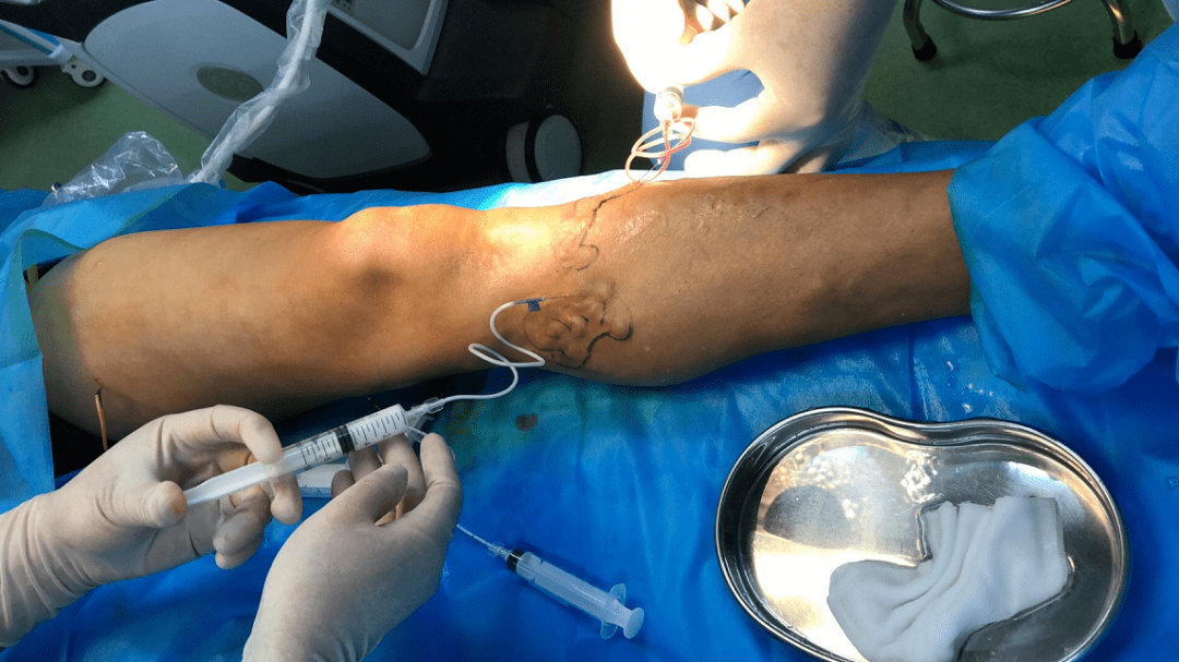 多在秦教授指导下进行操作手把手教学最后一位患者为坐骨结节囊肿患者