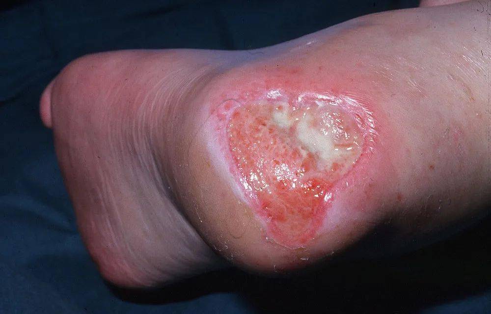 视频如何用水果学习压力性损伤分期