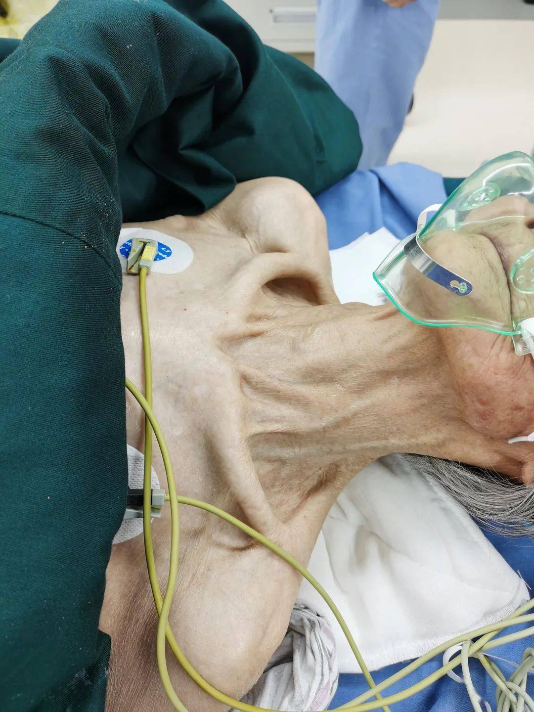 陈邦飞主任医师看到赵奶奶的时候,也着实吃了一惊,"她真的是非常瘦小