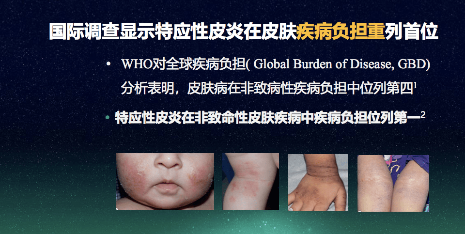 疾病负担在非致命皮肤病里列第一,中国特应性皮炎患者生存状况调研