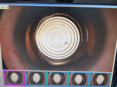 的年龄和职业要求,是选择panoptix03自然视觉三焦晶体的原因之一