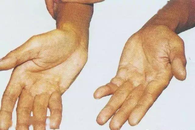 干货▏掌腱膜挛缩症的针刀治疗