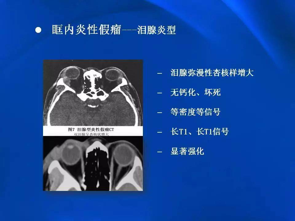 眶内炎性假瘤影像学表现