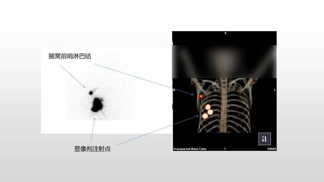 照亮哨兵,护卫你的美——大医二院在东北地区率先开展核素定位肿瘤前