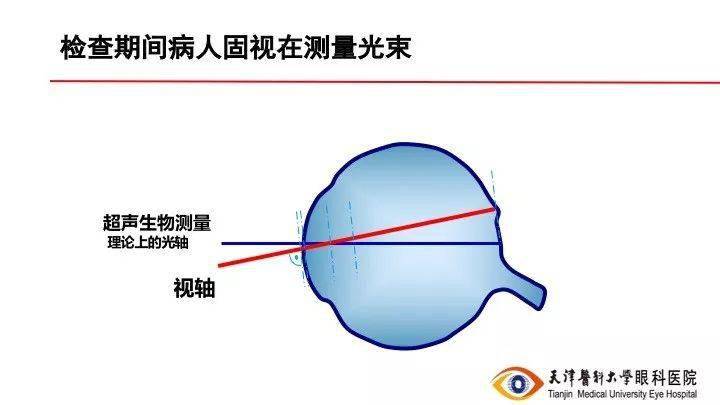 【眼視光】眼軸長度解析_測量