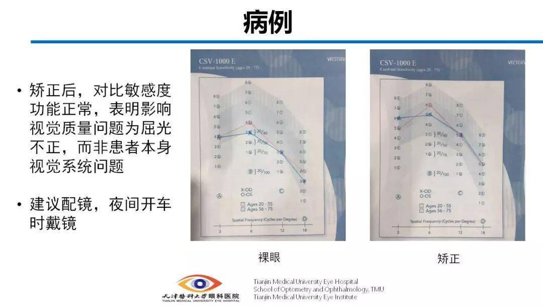 之后我们在全矫状态下为患者进行了cs检查, 发现对比敏感度功能达到