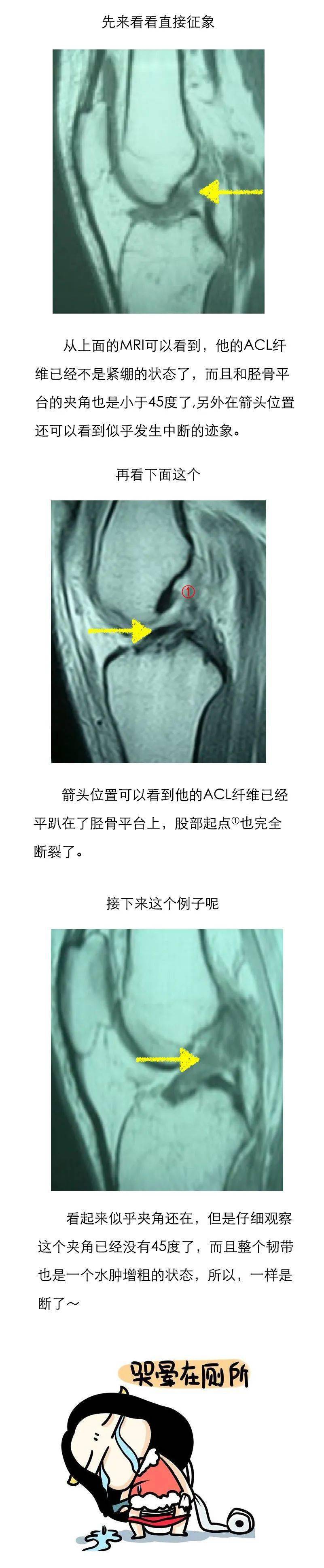 前交叉韧带核磁解剖图图片