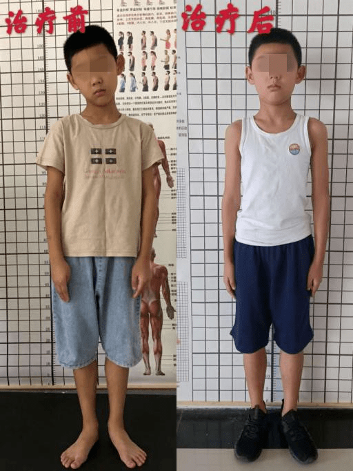 第一期姿势不良训练营结营16个孩子通过训练改善体态
