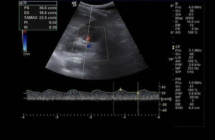 肾动脉解剖位置超声图图片