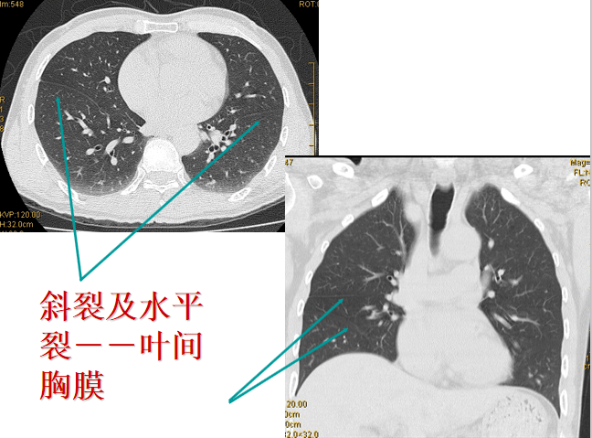 六分區:在側位胸片上,從胸骨柄體交界處至第4胸椎下緣畫一水平線,做為