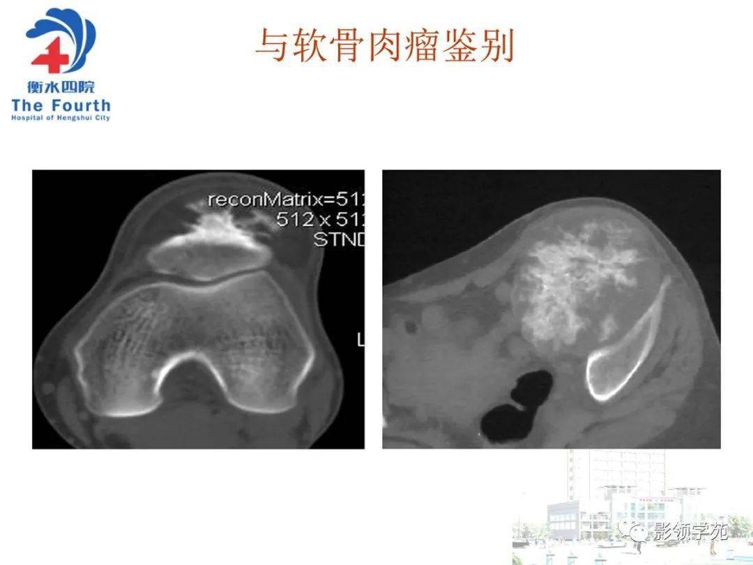 小结:髌骨肿瘤虽然少见,仔细观察影像学特征,再结合临床,大部分病例
