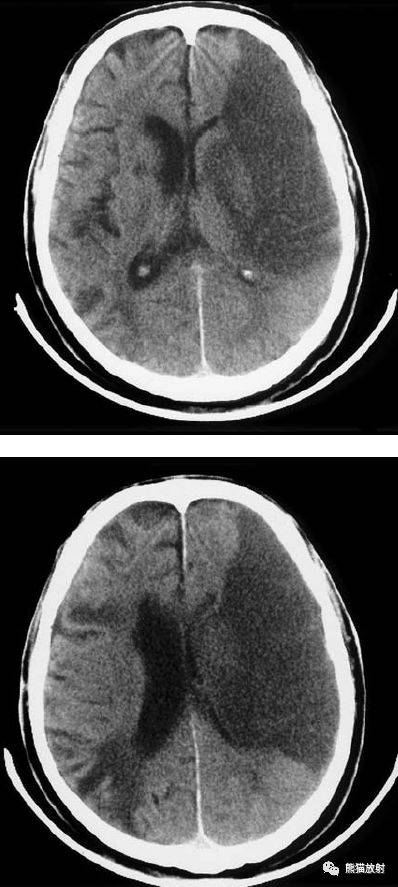 脑梗死丨演变血供区域分布ct表现