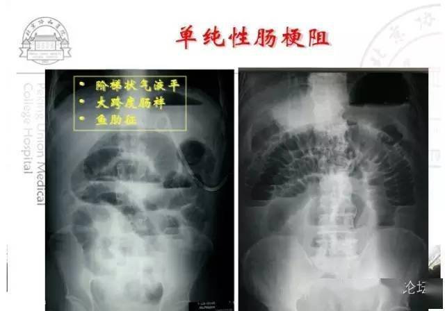 1腹部平片:胃腸道穿孔性或梗阻性急腹症 2,鋇灌腸造影:腸套疊,扭轉等