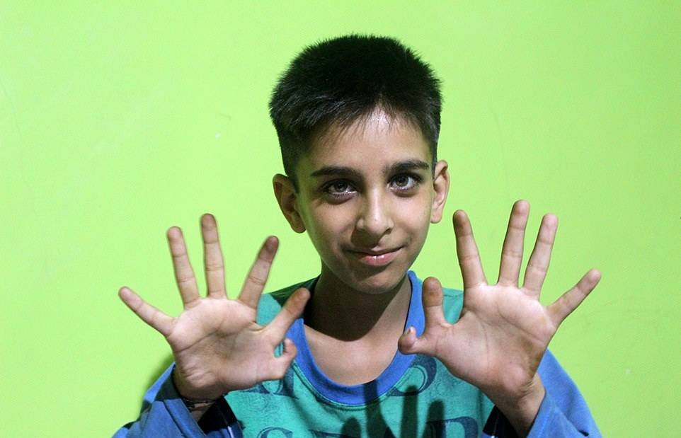印度12岁男孩天生双手六指称有助于赢得电子游戏