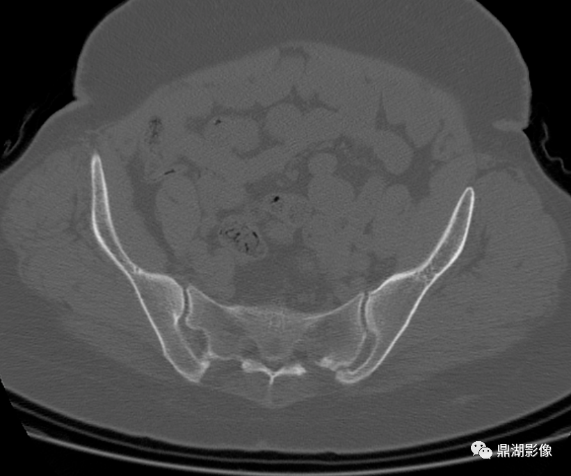 解剖变异副骶髂关节accessorysacroiliacjoint