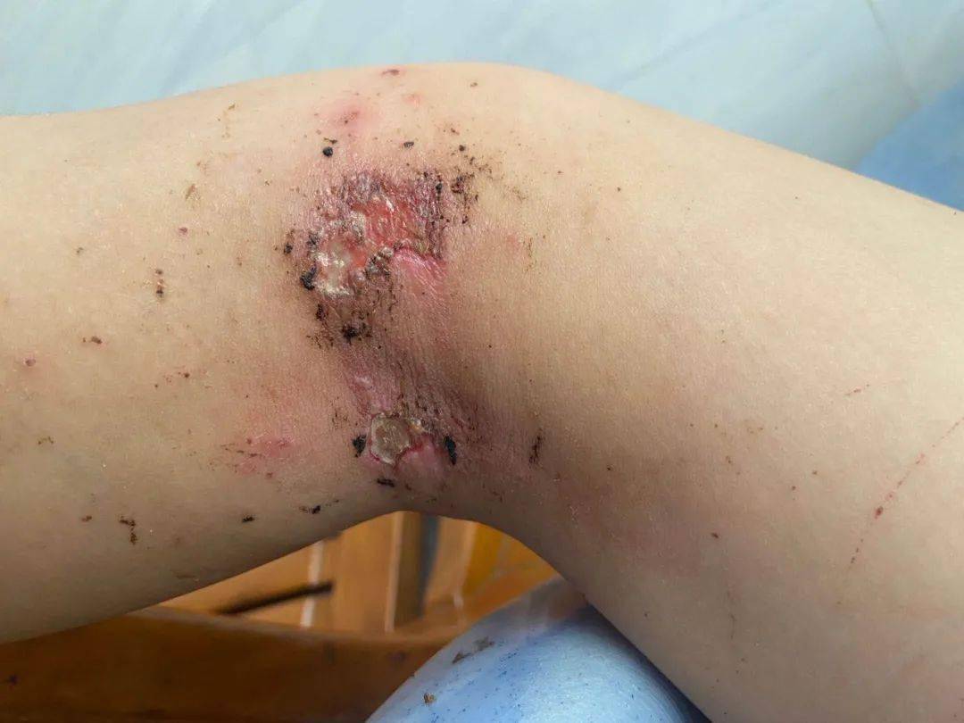 惊悚事发漳州一对父子沾到路边积水身上多处腐烂怎么回事