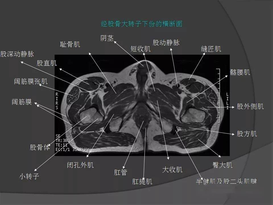 骨盆肌肉解剖图横断位图片