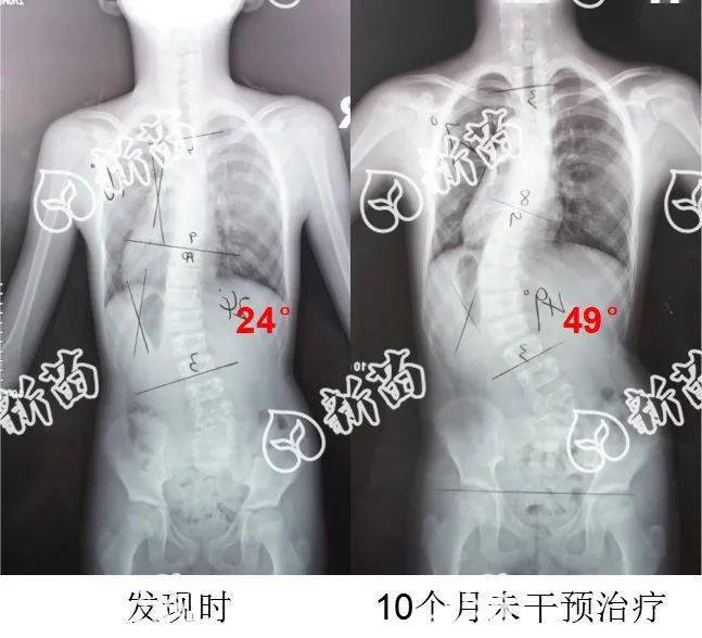 小孩颈椎侧弯图片图片