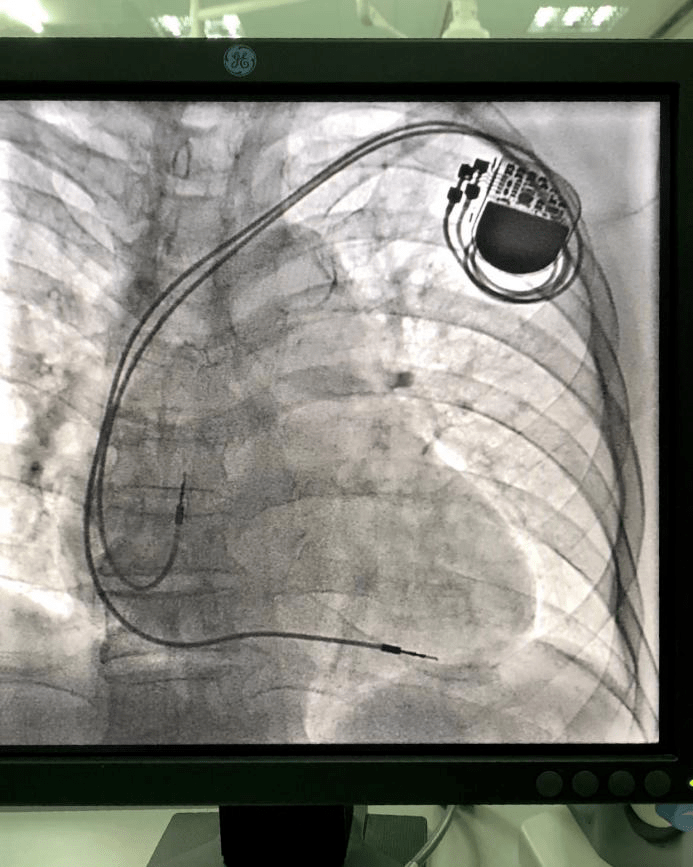 又有新突破鹤山首例永久起搏器植入术成功开展
