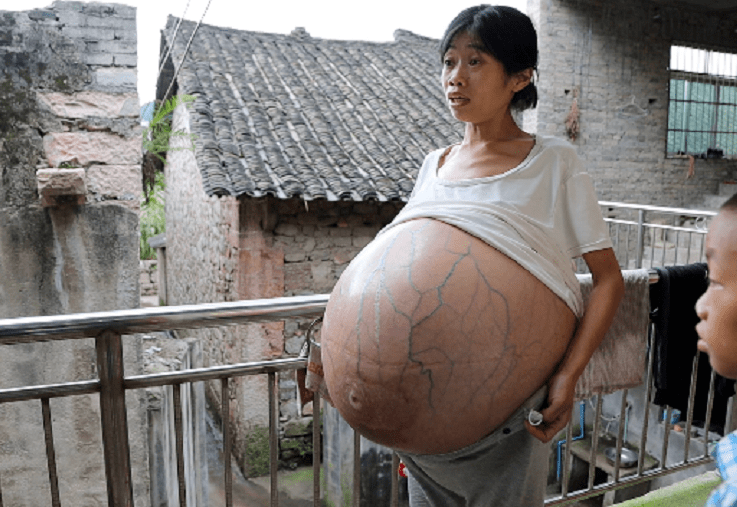 黄国娴说,有医生说她肚子内是腹水,于是给她抽了一周的腹水,起初肚子