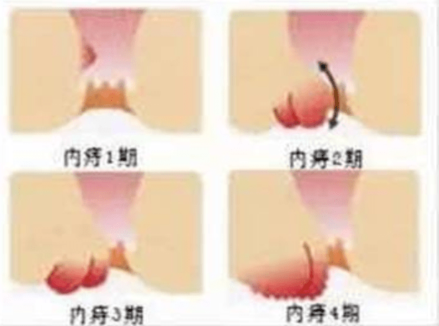 痔在必除内镜下内痔硬化术让您有痔无恐