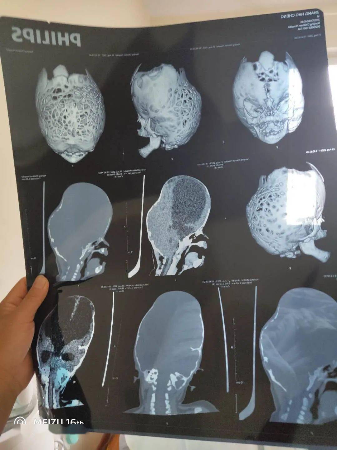 罕见疾病长春6个月宝宝头部畸形图片让人心痛