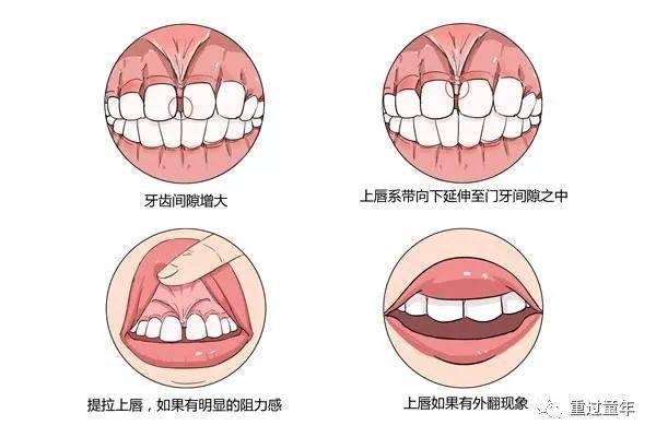 以下几点也可以帮助家长初步进行一个判定:上唇系带向下延伸至门牙