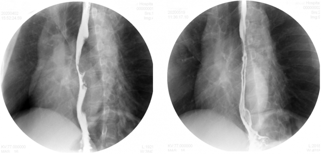 快速缓解,疗效明确:免疫联合化疗新辅助2周期,iiib期食管鳞癌实现术