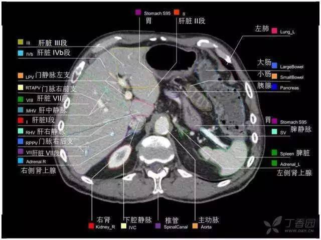上腔静脉解剖图ct图片