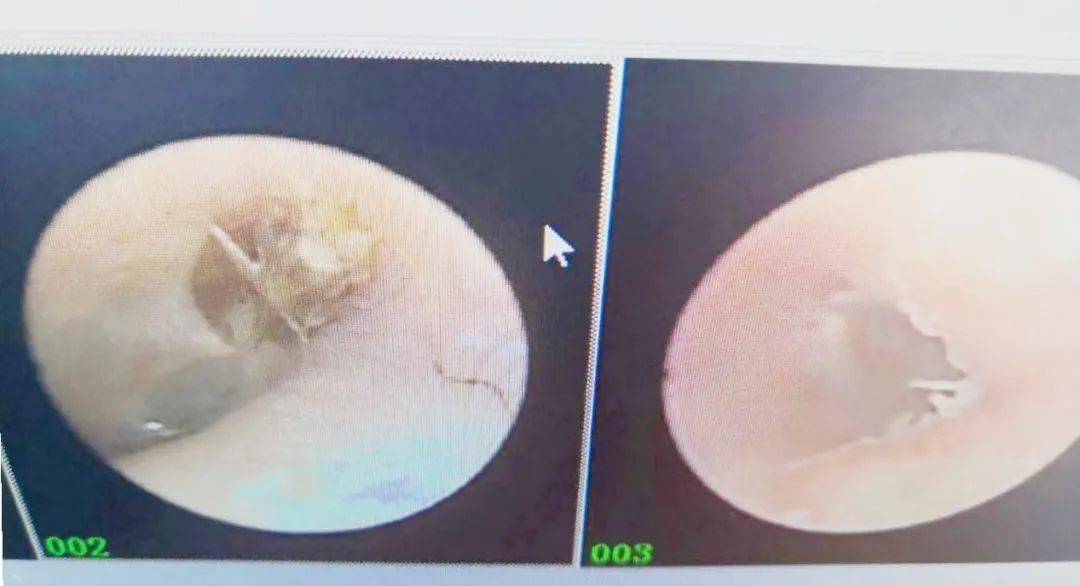 在内镜室,刁护士用耳内镜检查,发现贴近鼓膜处有一白色异物,用专用