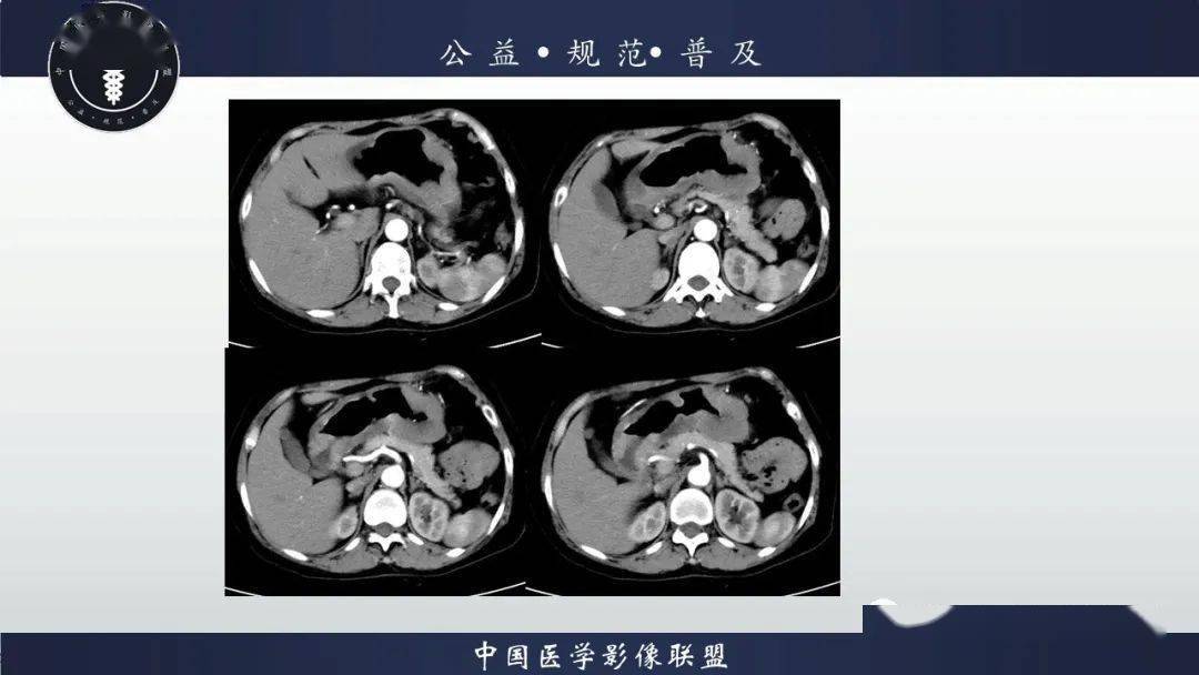 正常充盈的胃的胃壁厚度為2--5mm,如果胃壁>10mm,為胃壁異常增厚.