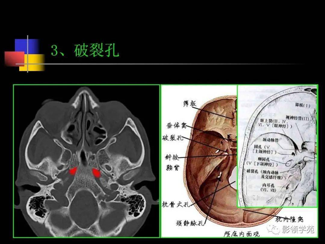 鼻前棘解剖图谱CT-千图网