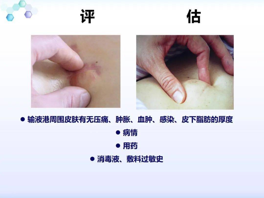 【ppt】输液港的维护和并发症护理