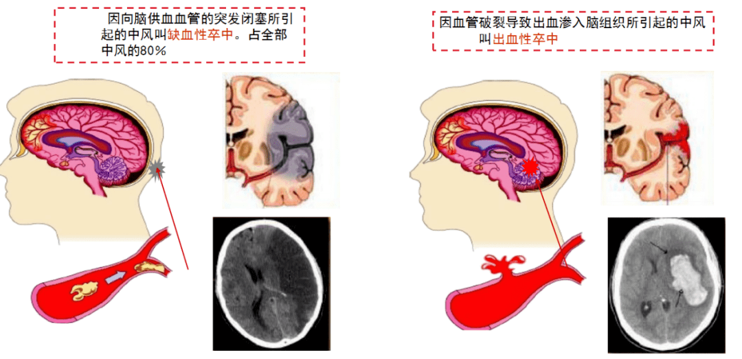 北京清華長庚醫院神經內科針對急性缺血性腦卒中搶救採取兩個重要方式