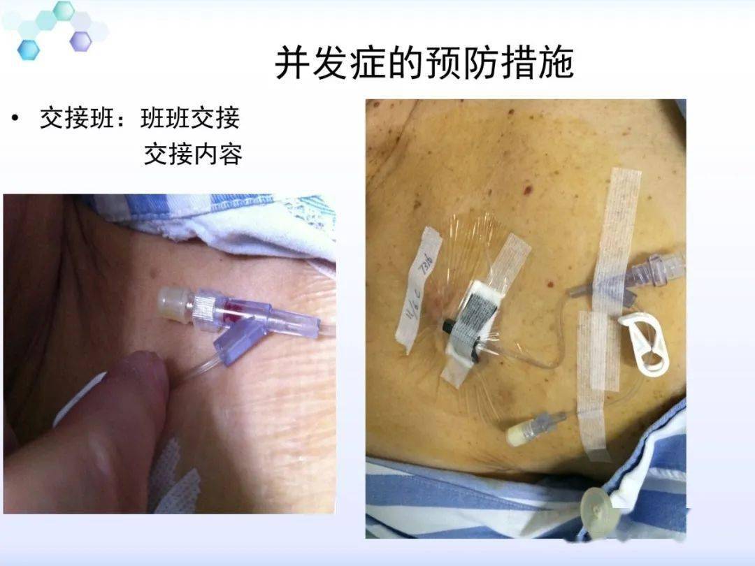 【ppt】输液港的维护和并发症护理