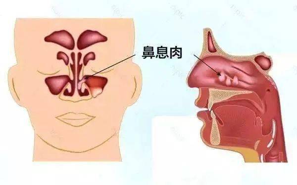 鼻息肉很少會癌變.但長大的息肉依然要重視並積極治療.