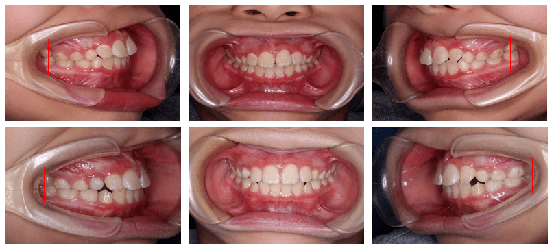 學檢查圖9治療後口內觀圖8治療後面相下頜乳尖牙處預留尖牙萌出空間